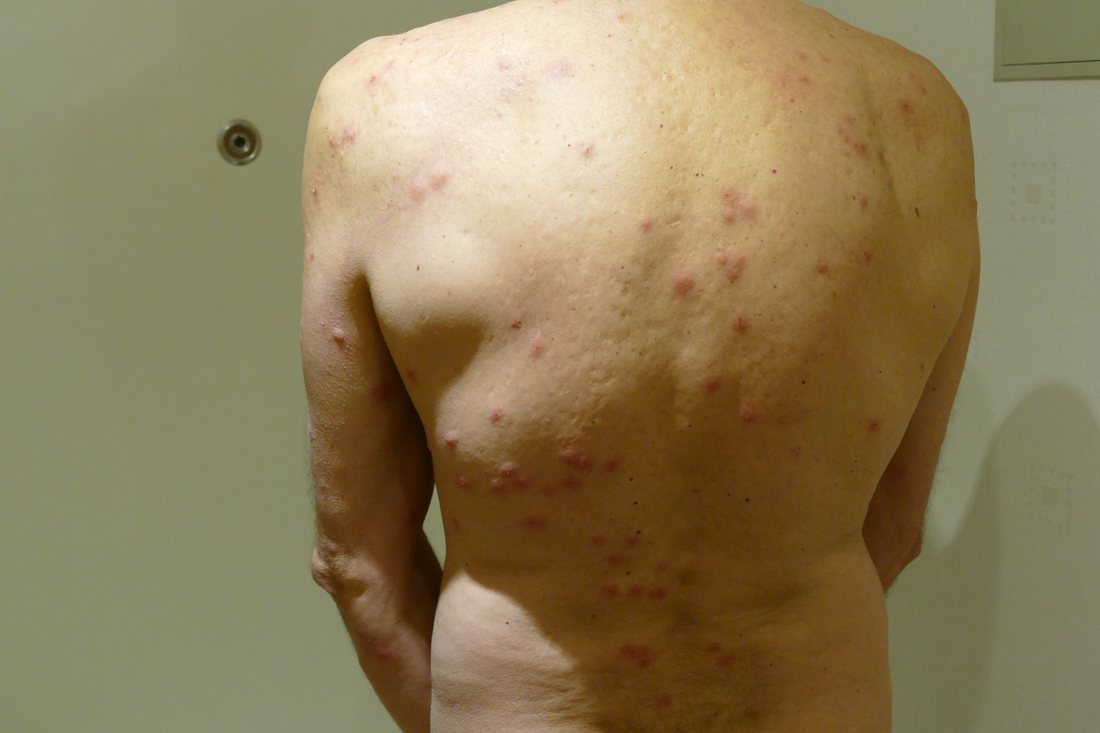 A man's back and upper arm covered with dozens of small red raised bite marks