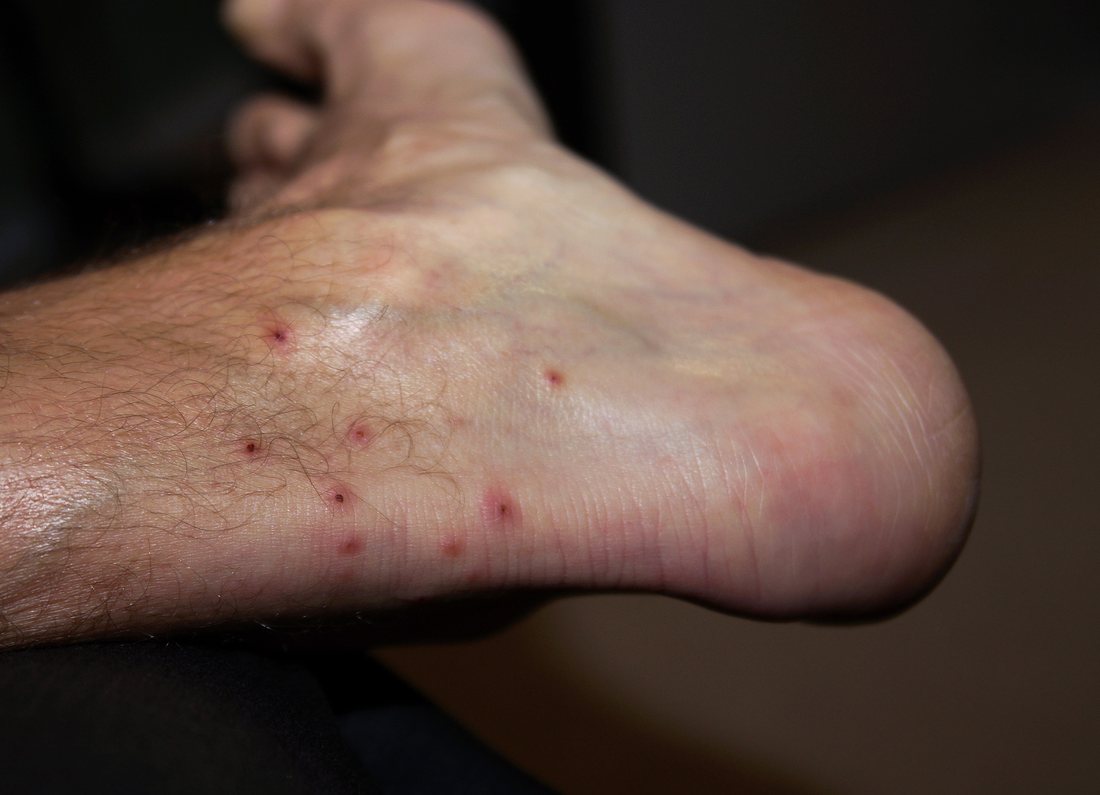 The side of a foot with about ten small raised red bumps spread over the skin