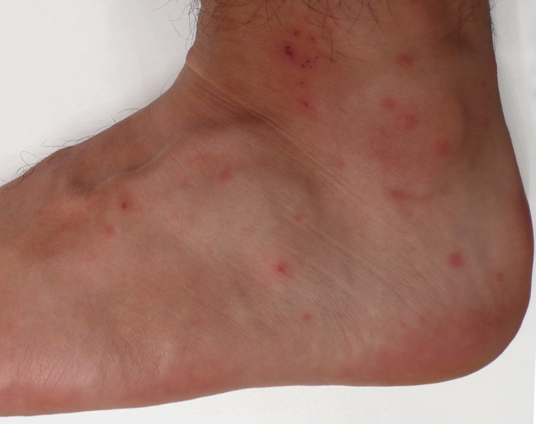 A foot and ankle with a dozen small flat red spots scattered over the instep and above the heel
