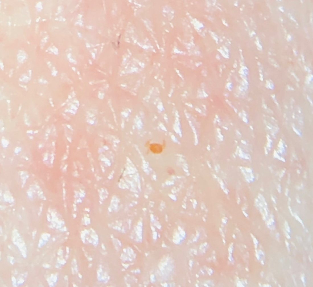 Microscope view of pale human skin with a single tiny orange-red mite larva on the surface