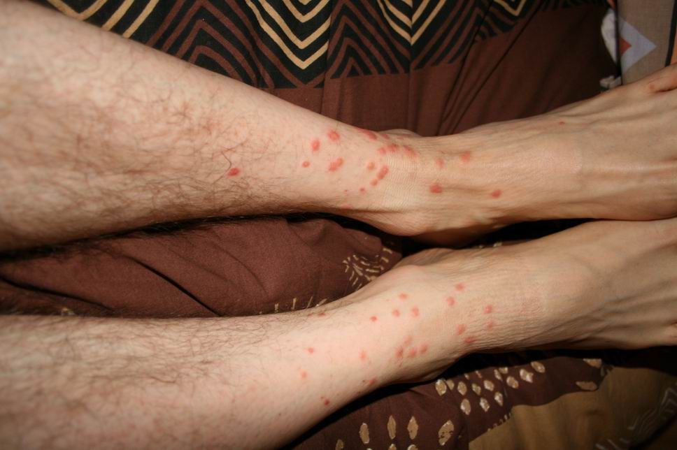 Two forearms resting together, covered with many small red spots a few millimetres across