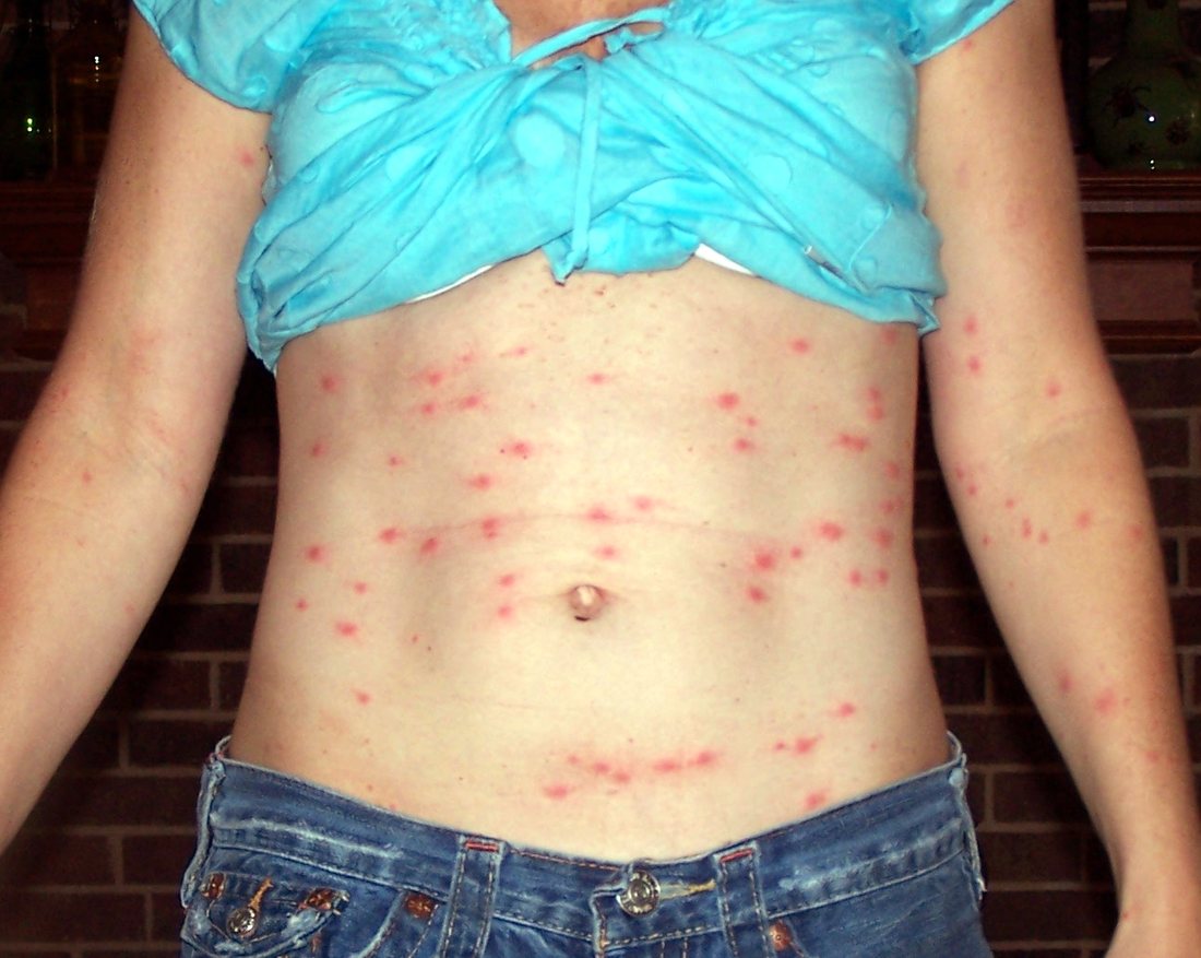 A midriff with several dozen small red raised spots concentrated in a broad band across the waistline