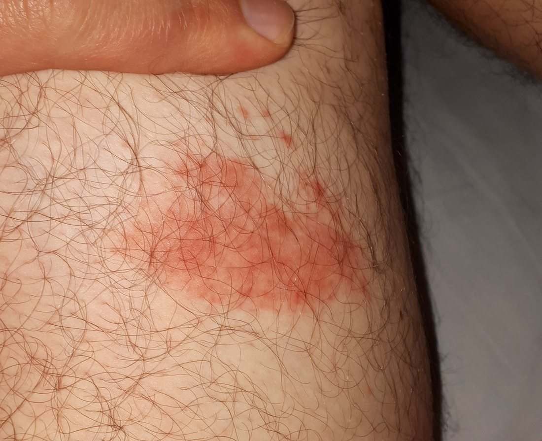 A thigh with a diffuse blotchy pink patch, irregular in outline