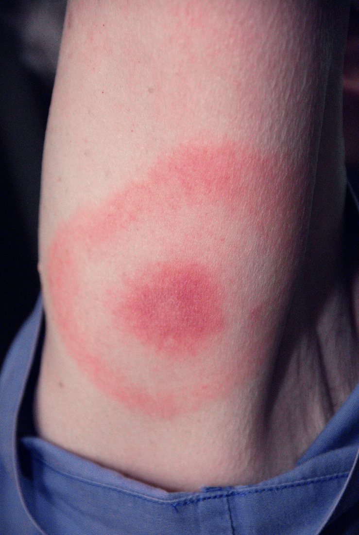 An upper arm with a large red ring surrounding a red centre and clear skin between them