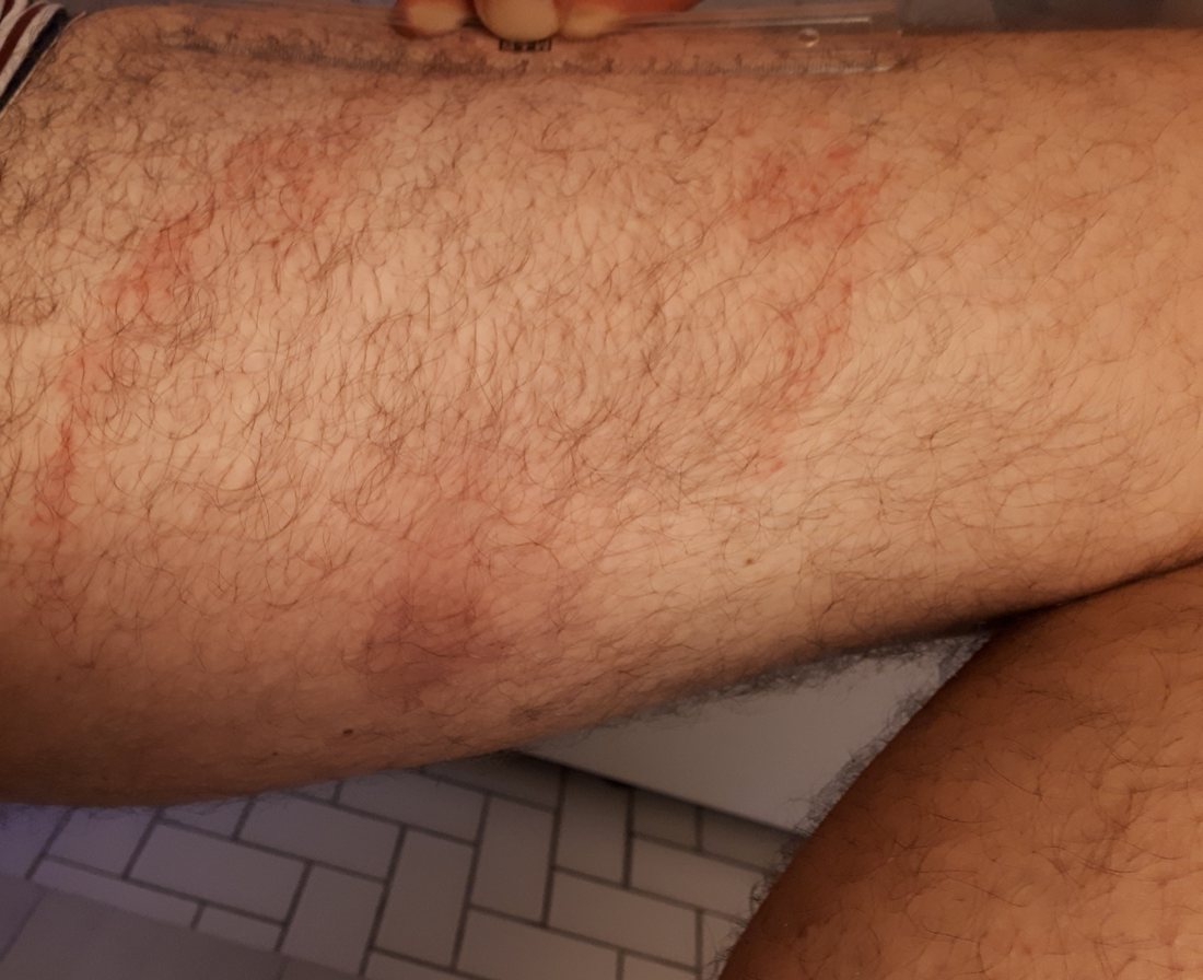 A thigh with a large faint pink area, its edge blurred into normal skin