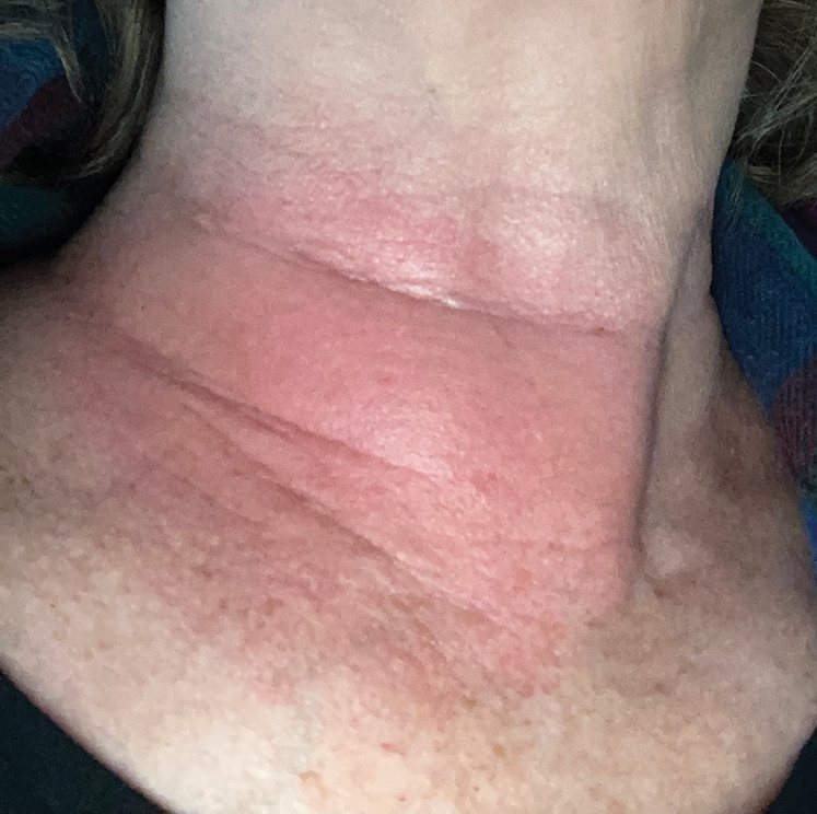 The side of a neck with a broad, evenly red patch and no ring pattern