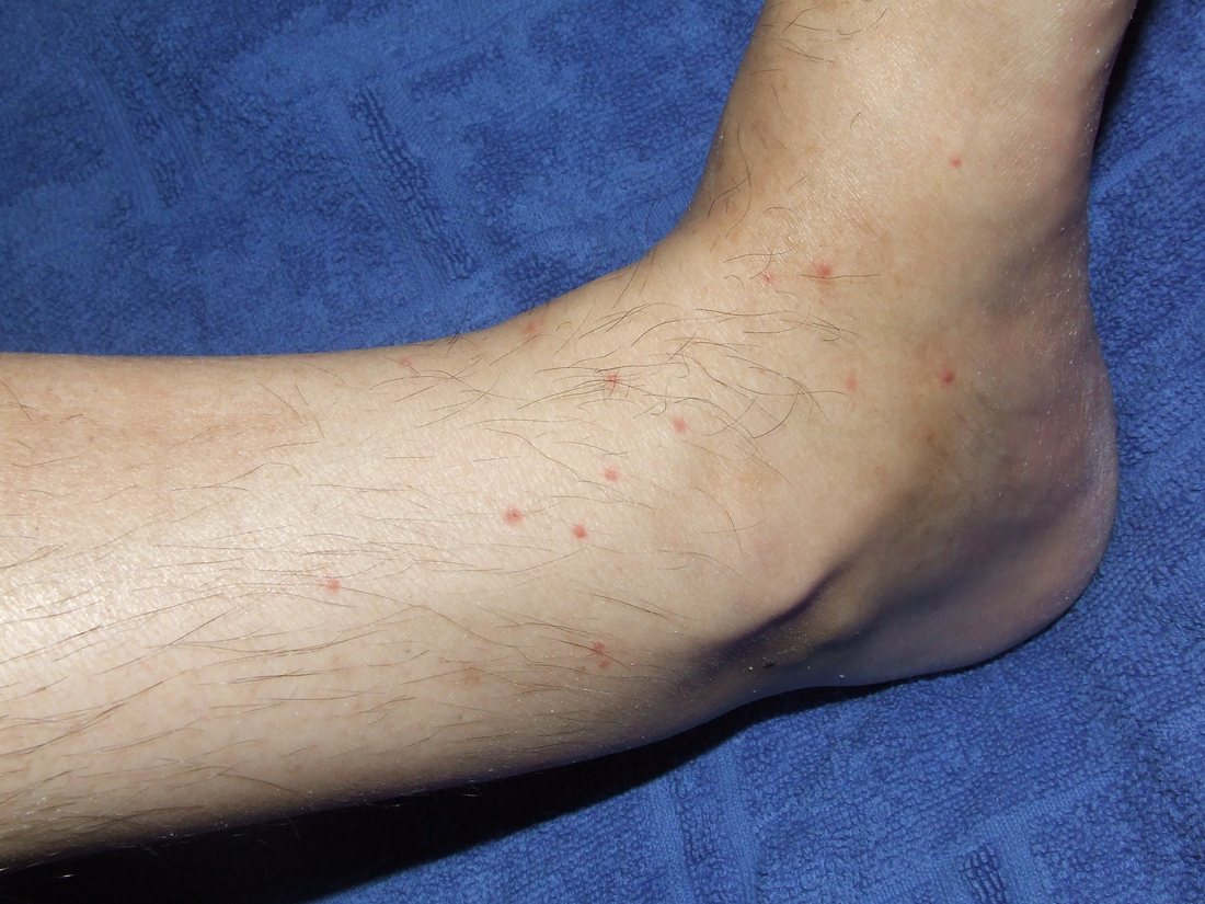 An ankle and lower leg resting on a blue cloth, with about a dozen small red spots spread over it