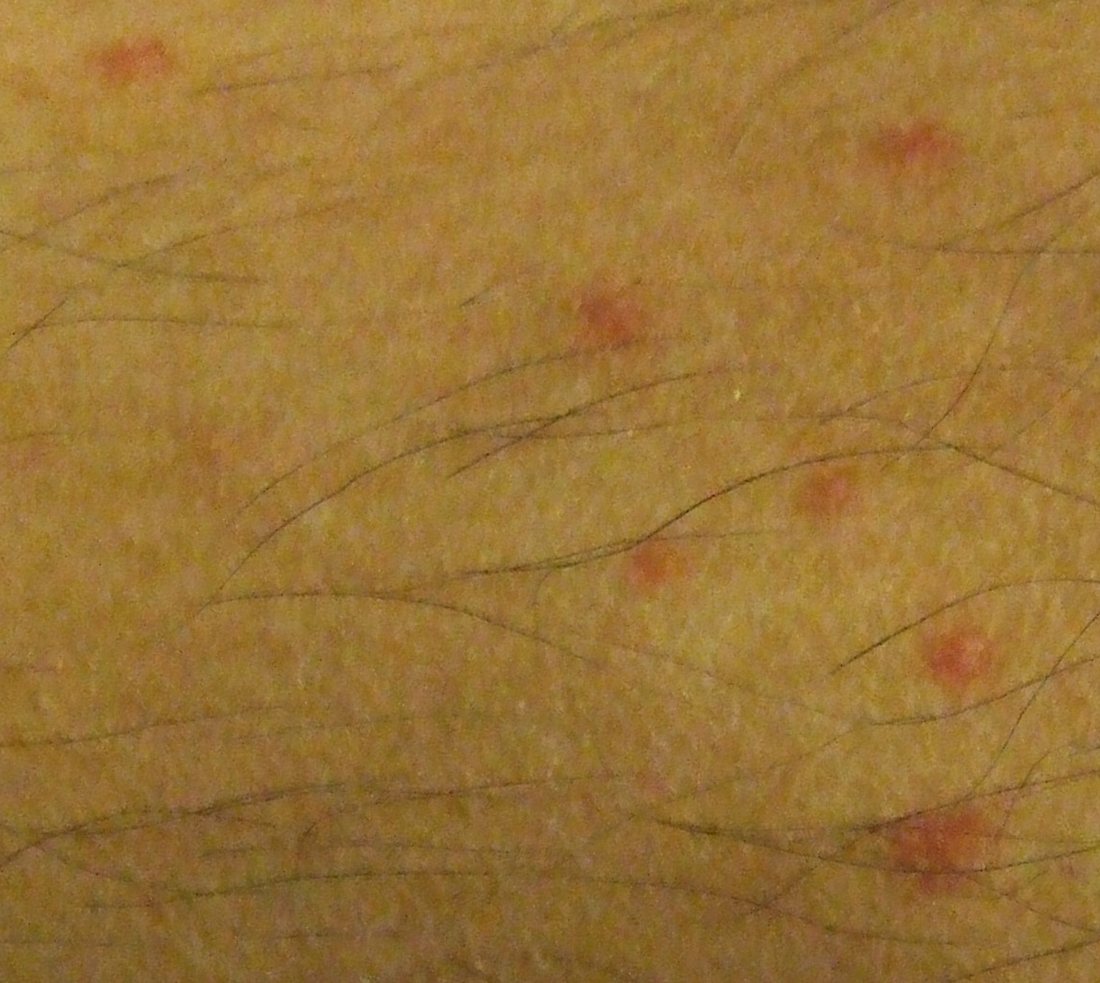 Close-up of skin on a lower leg with five small red spots, each a few millimetres across with a darker centre