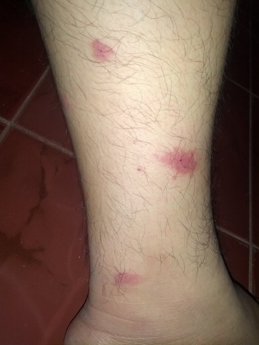 A lower leg with three separate round pink welts, each about a centimetre across, spaced several centimetres apart