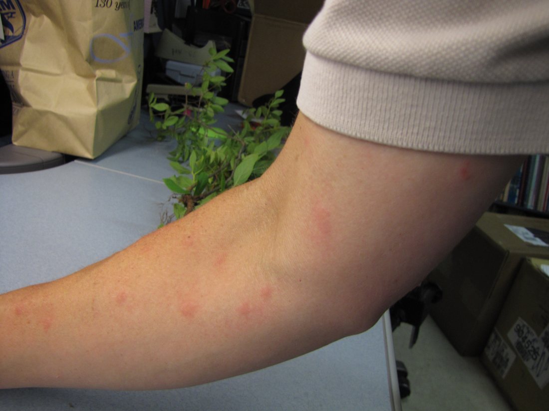 A forearm with about eight pink raised spots scattered irregularly across it