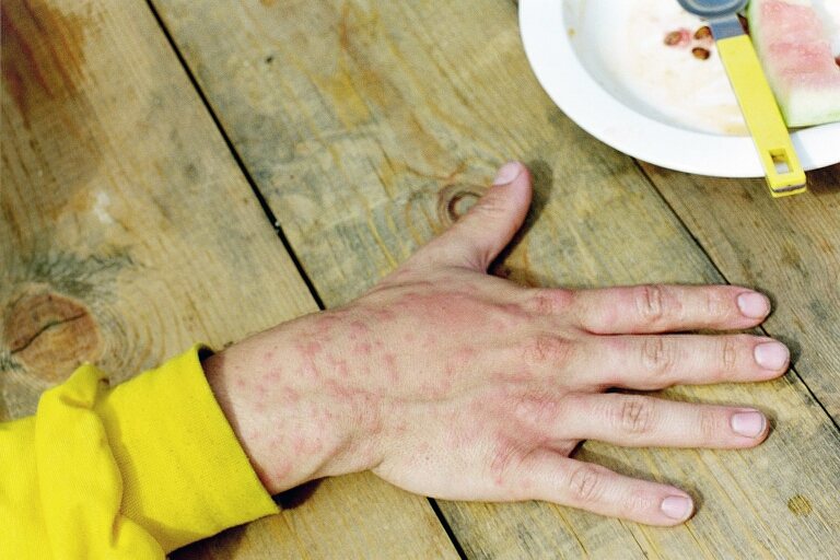 The back of a hand resting on a wooden table, with about a dozen small red spots across it