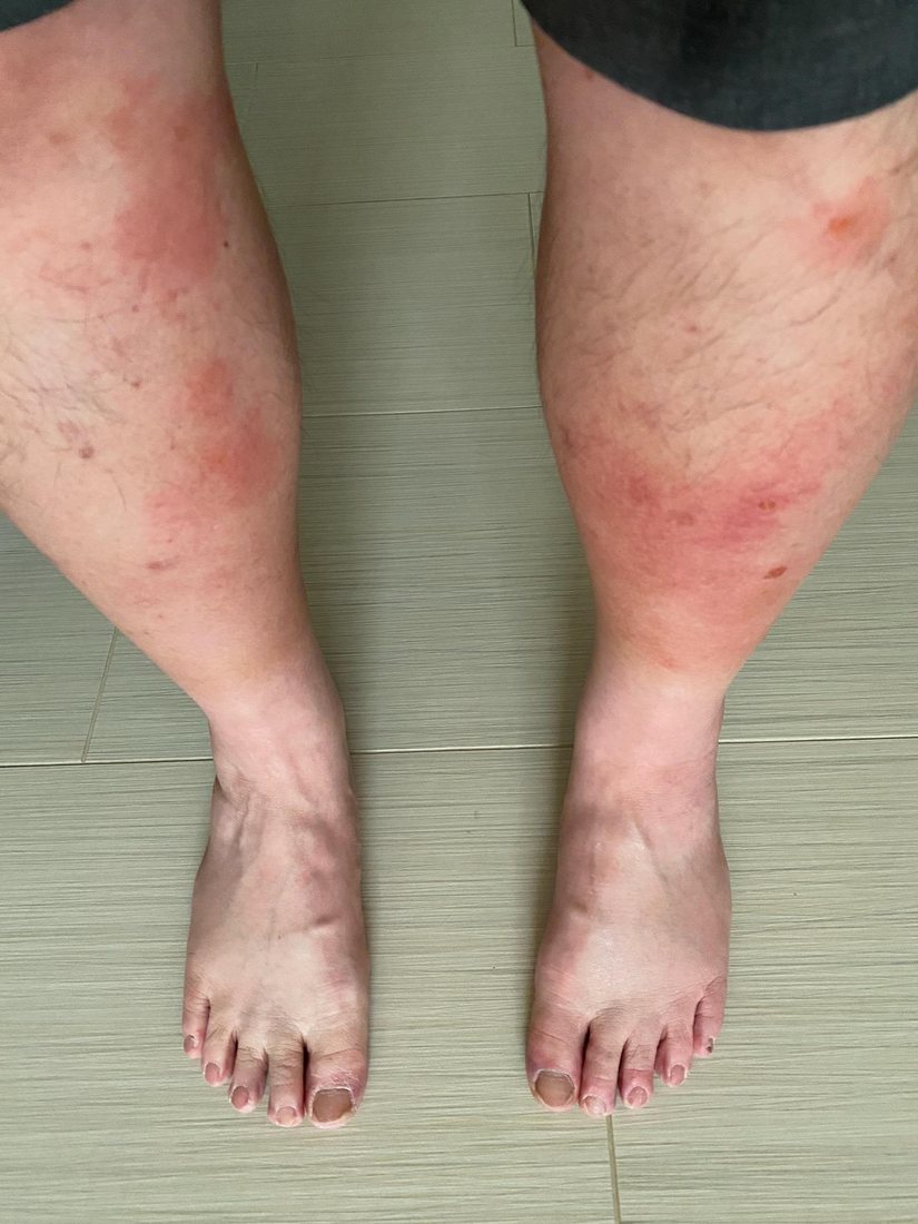 Both lower legs and feet seen from the front, covered with dozens of small red spots