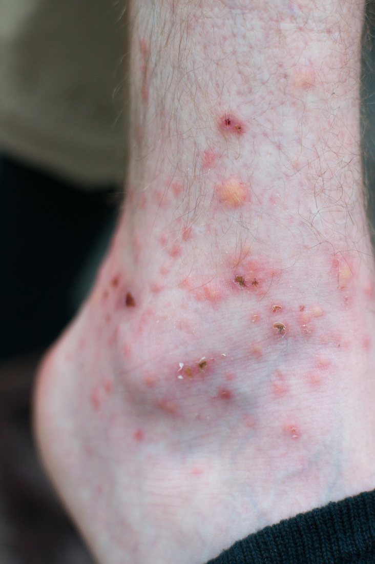 An ankle and lower calf with many inflamed red spots, several of them scabbed over and surrounded by dry skin