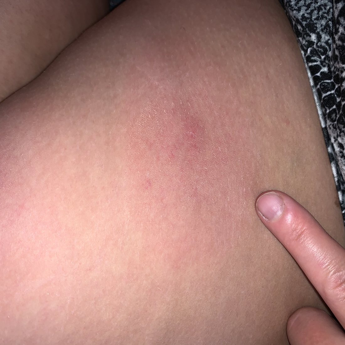 A broad pink swollen area on a thigh, wider than the hand resting beside it for scale