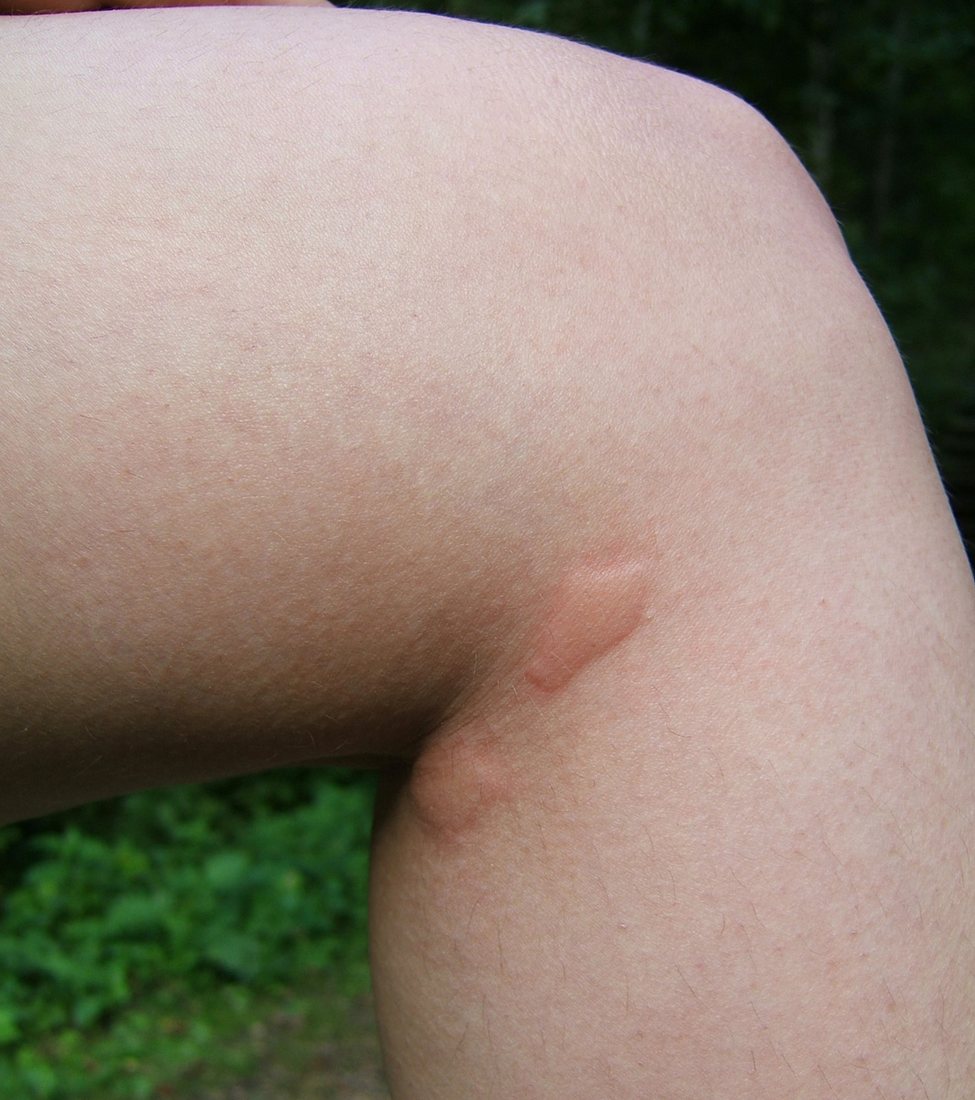 A pale raised bump about five millimetres across on the back of an upper arm, with slight pink colouring around it