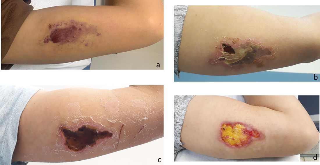 Four panels of a limb with a large dark necrotic area that gradually becomes a healing wound
