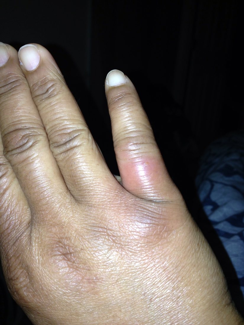 A puffy, reddened hand and fingers photographed against a tiled floor, the swelling spread across the whole back of the hand