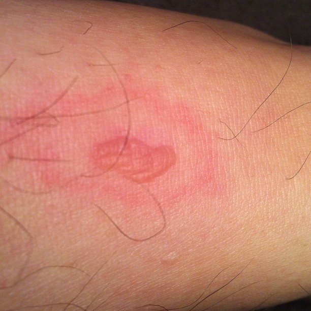 A red patch of skin several centimetres across with a paler, slightly sunken area at its centre