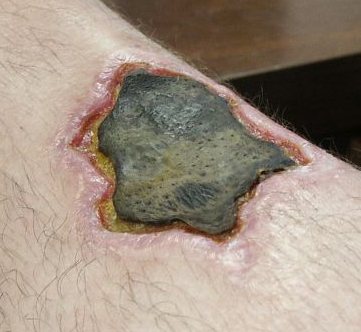 Close-up of the same necrotic wound, grey dead tissue with a yellow and red border