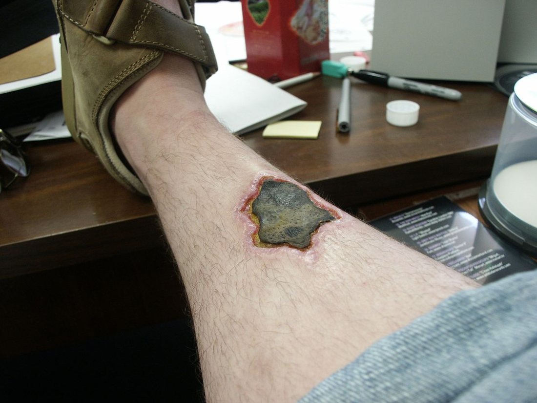 A lower leg with a dark sunken patch of dead skin about three centimetres across, ringed by red inflamed skin