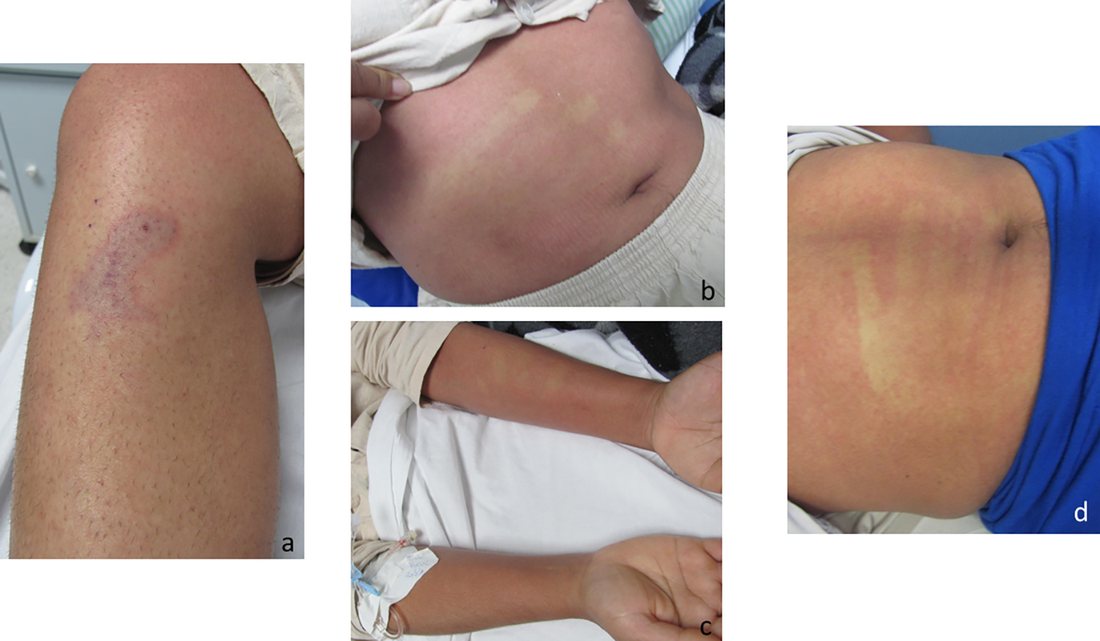 Panels showing a mottled patch at a bite site and a widespread fine red rash on a forearm and abdomen