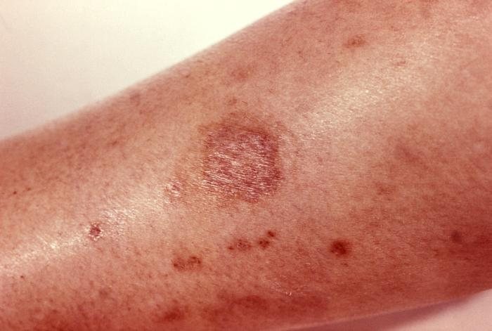A forearm with a round healed scar about a centimetre across, pale in the middle with a red rim
