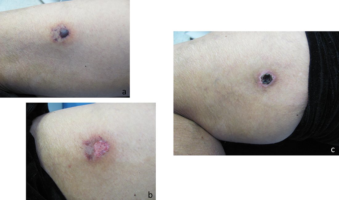 Three panels of an arm showing a mottled red patch with a blister, then an open raw area, then a dry black scab