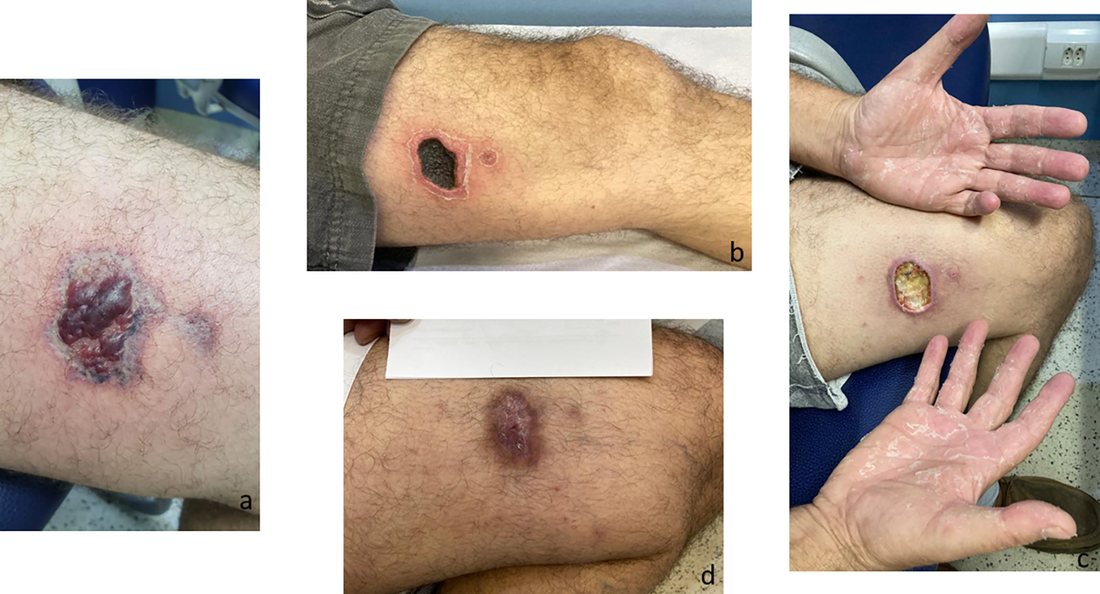 Four panels following one lesion from a red mottled patch through an open ulcer to a pale healed scar