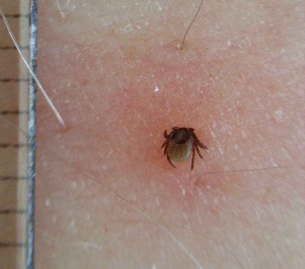 A small dark tick embedded in the skin of a leg, with a millimetre ruler beside it for scale