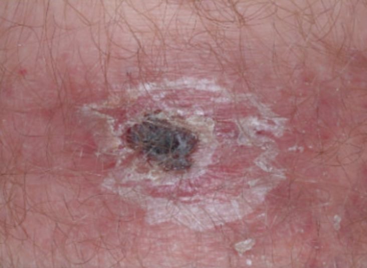 Skin with a black crusted scab about a centimetre across, ringed by pale flaking and red skin