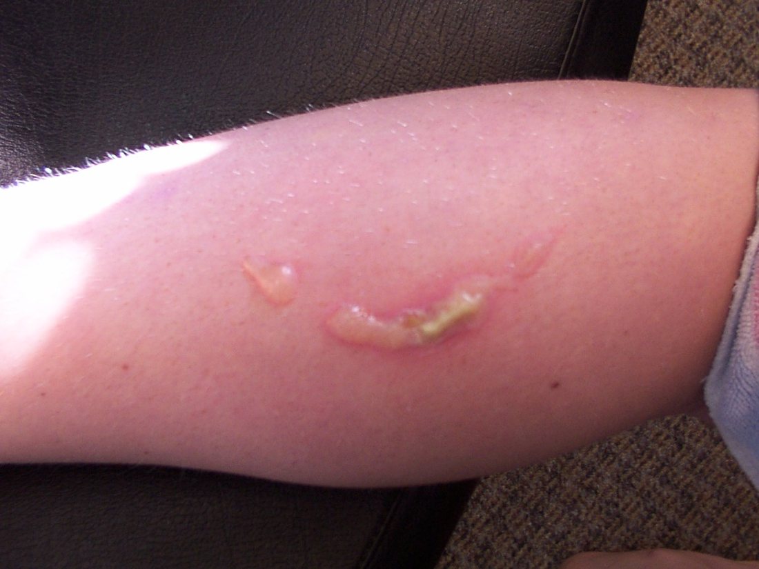 A forearm with one small pale blister and mild redness around it